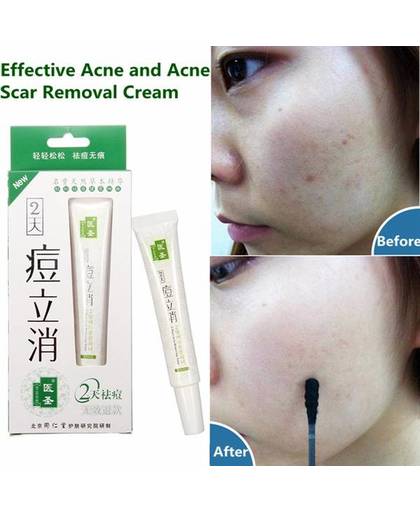 Acne Behandeling Creme